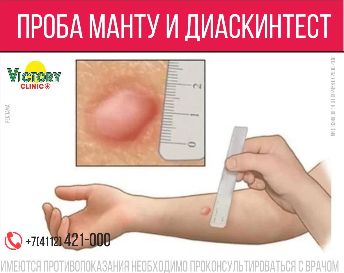 Диаскинтест Что Это Такое Фото Диаскинтест Что Это Такое Фото