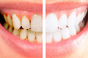 чистка зубов от стоматологии Victory Clinic