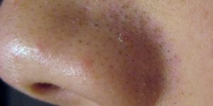 Blackheads_1504279255-630x315